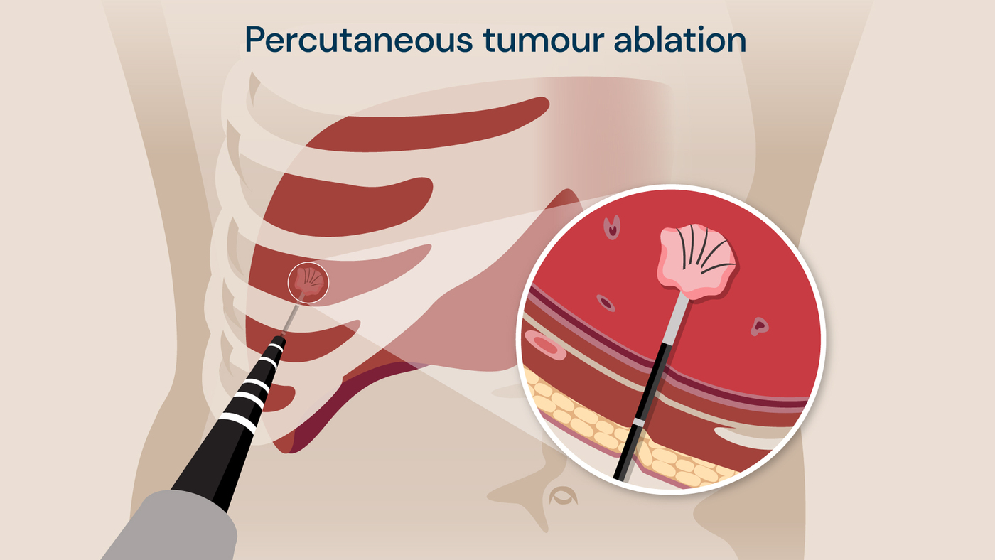 Percutaneous tumour ablation involves placing a probe through the skin into the lung, in order to provide treatment to the tumour directly