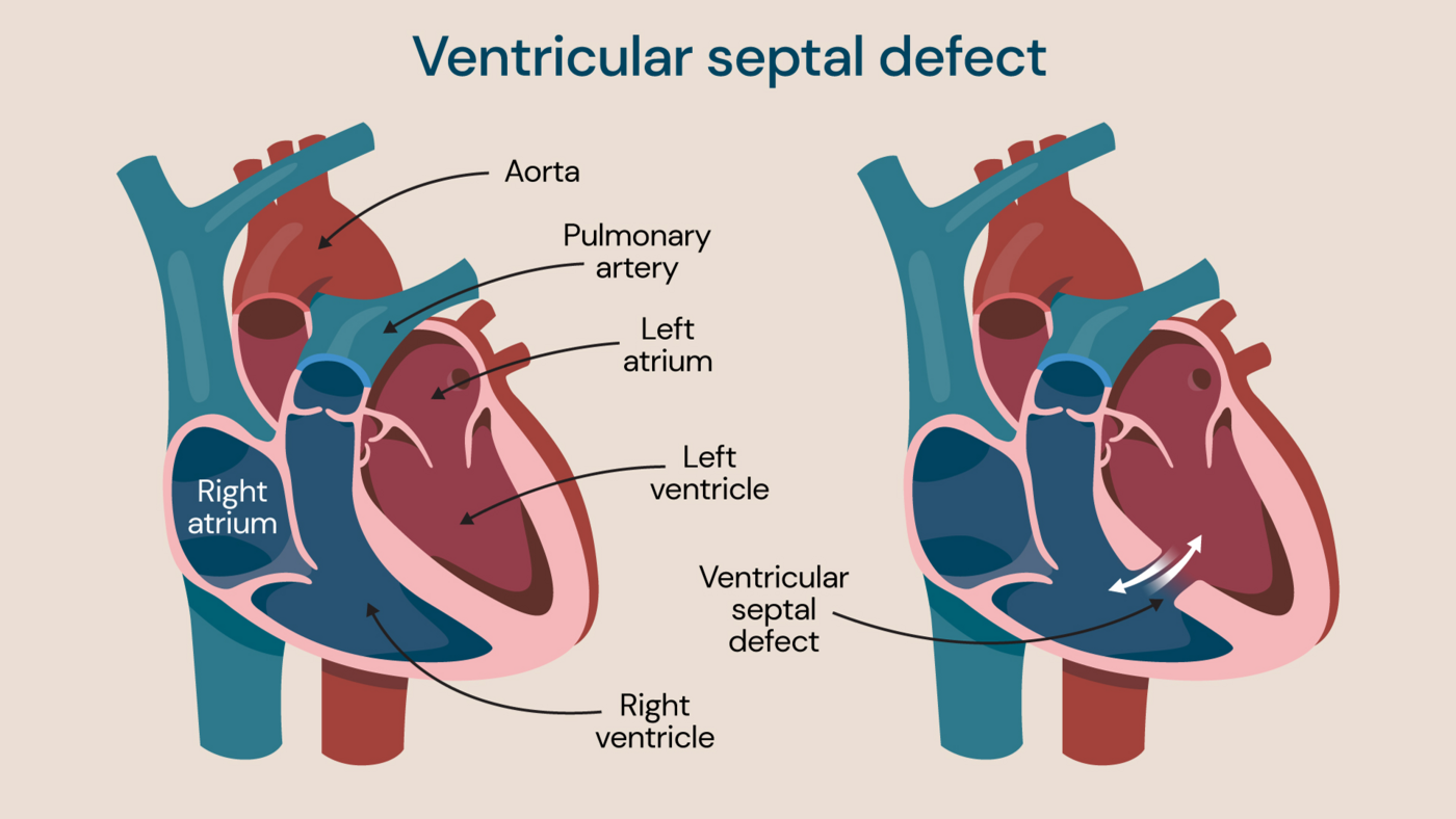 An illustration showing ventricular septal defect