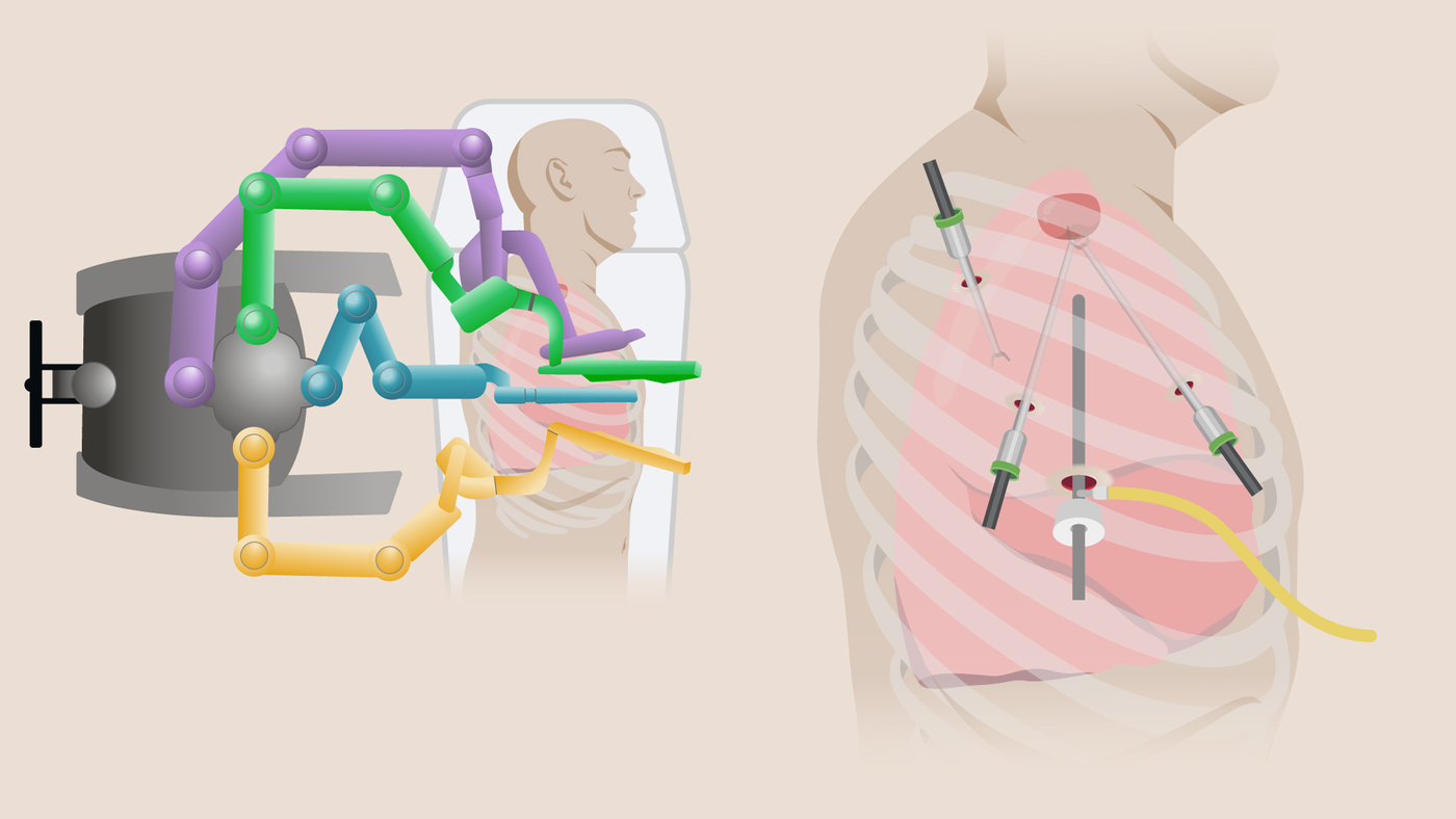 A visualisation of robotic-assisted thoracic surgery (RATS)