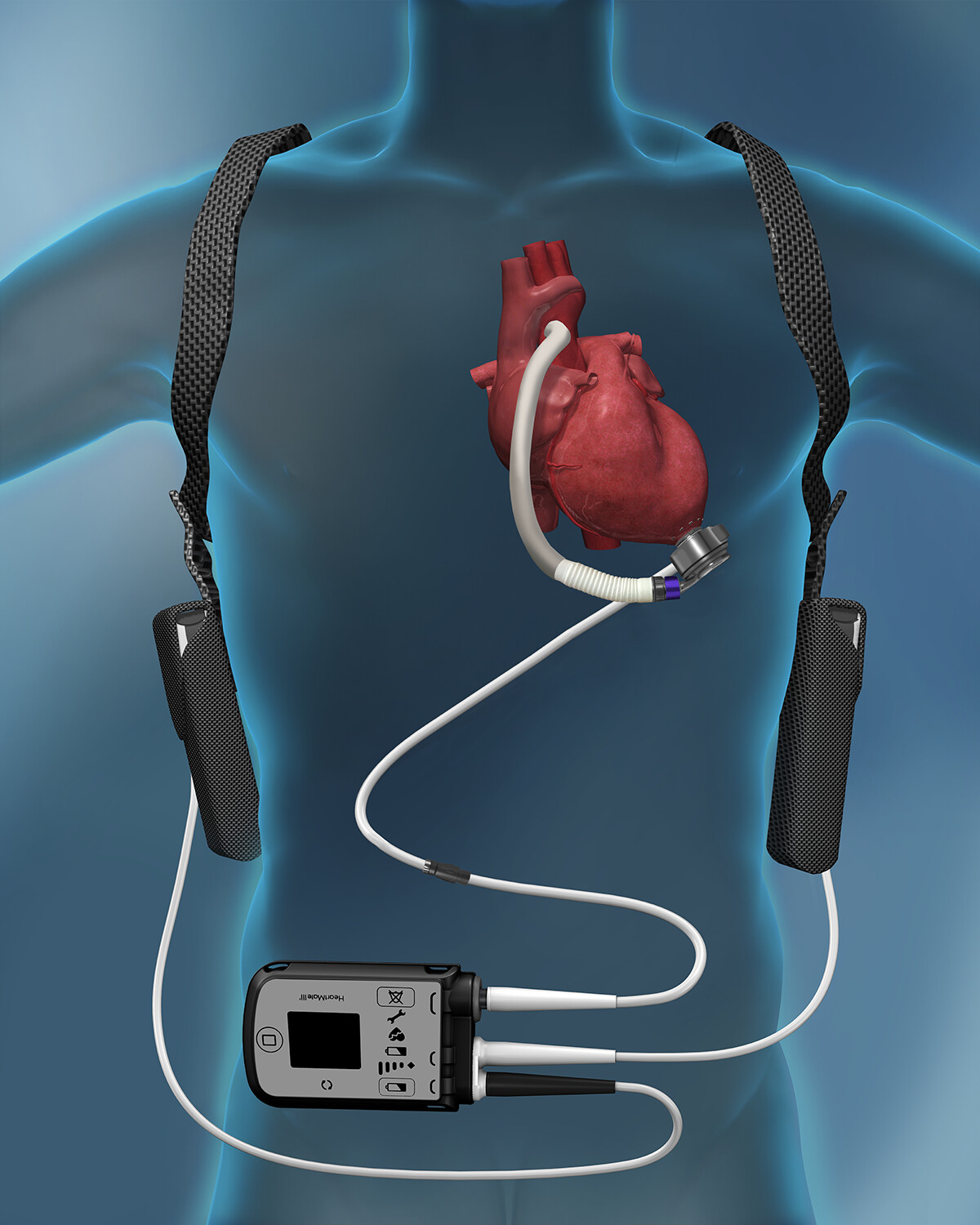 Depiction of a left ventricular assist device (LVAD) diagram by Abbott