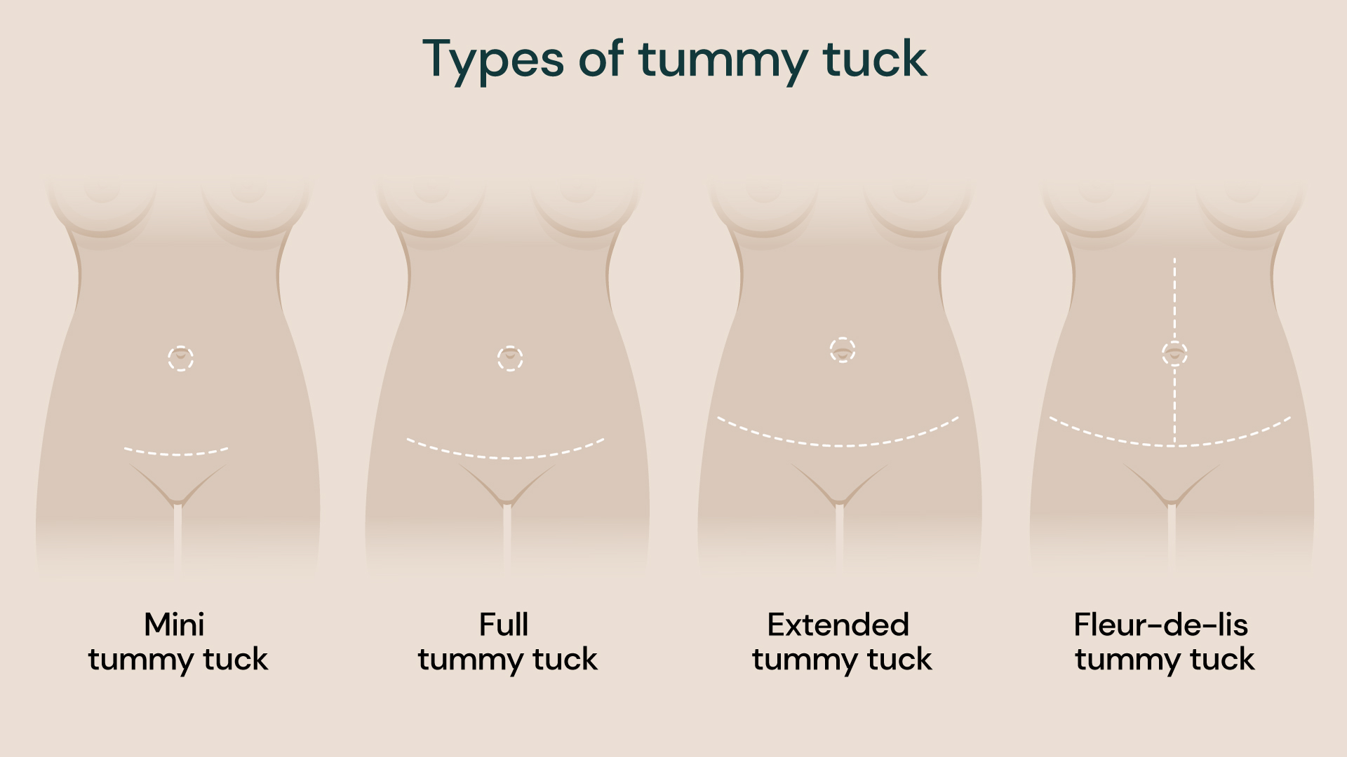 Illustration comparing types of tummy tuck procedures including mini, full, extended and fleur‑de‑lis abdominoplasty with incision placement.