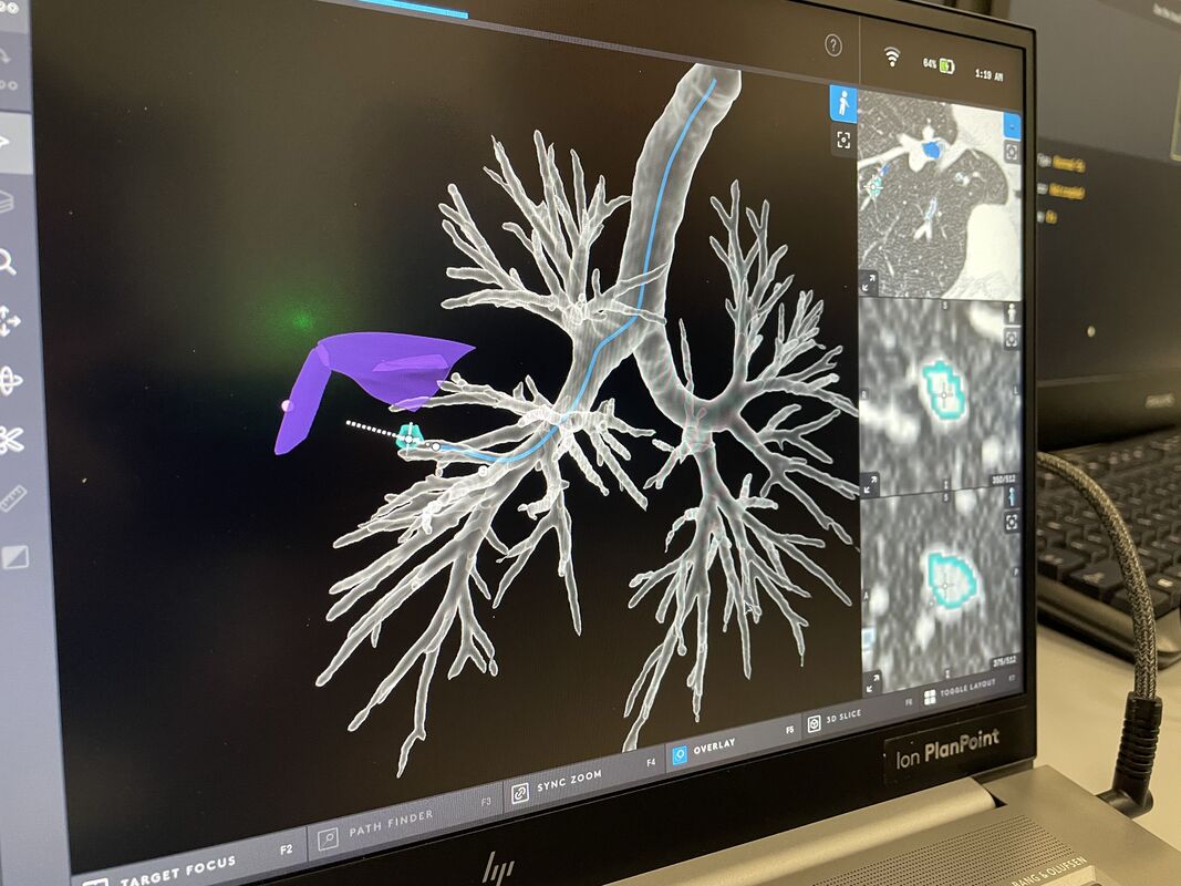 Ion 3D roadmap to guide accurate lung biopsy and surgery