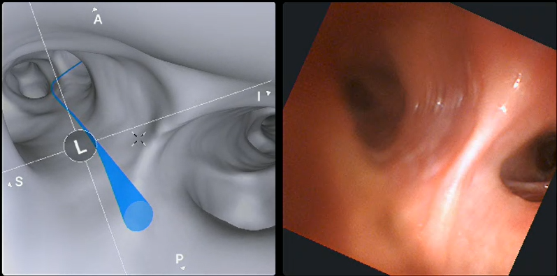 3D roadmap of the lungs with the suggested access routes to the tumour shown by the blue line