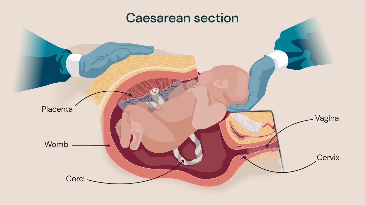 Caesarean section illustration