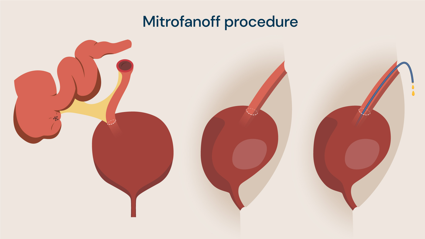 A tube is created from the appendix or small intestine (left) which connects the bladder to the outer abdominal wall (middle), allowing urine to be drained through a catheter (right).