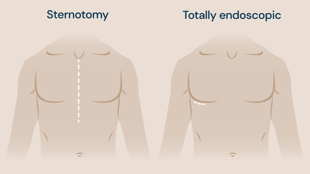A visual of endoscopic heart surgery.