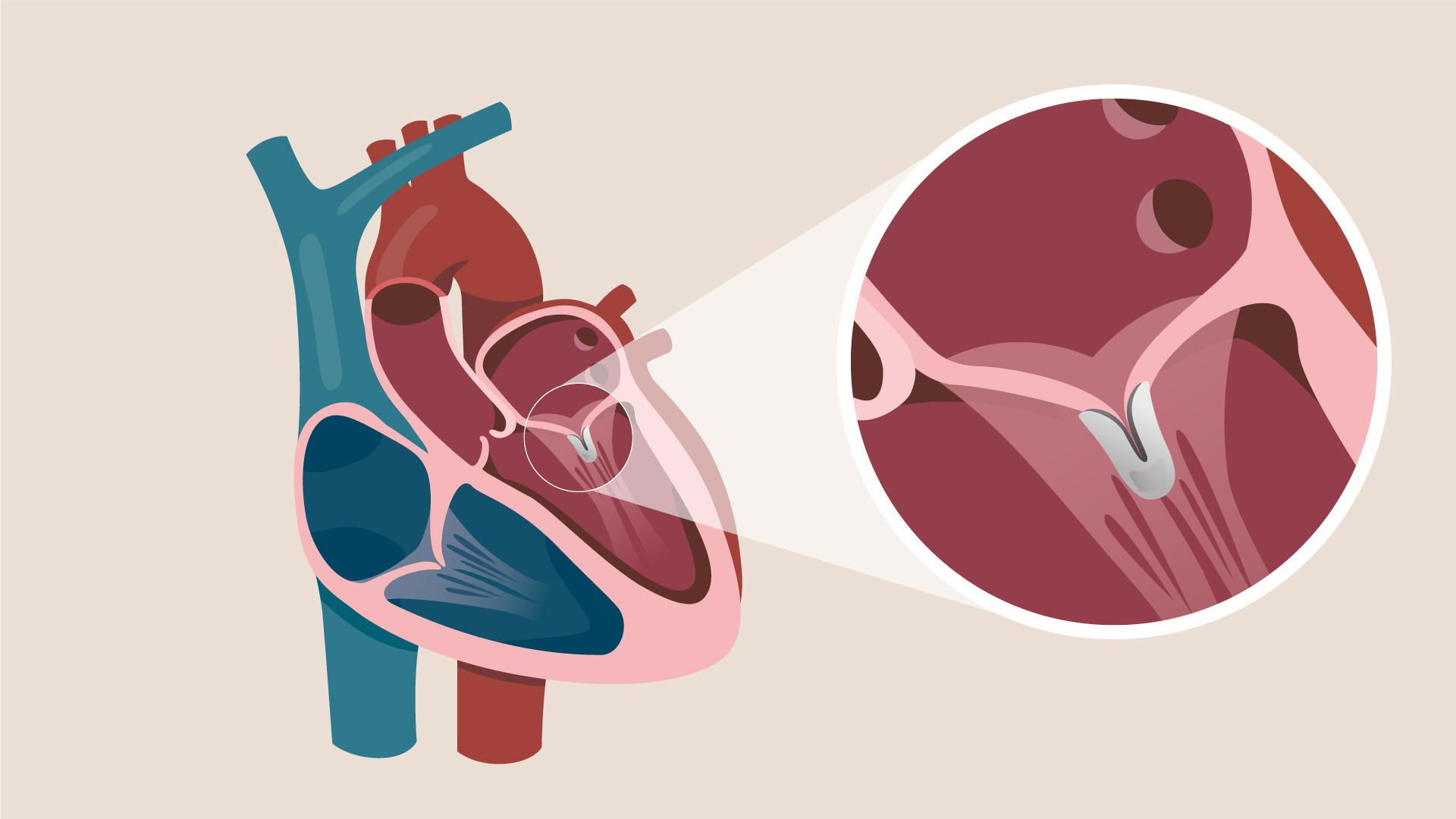 A diagram of the MitraClip device repairing mitral valve regurgitation.