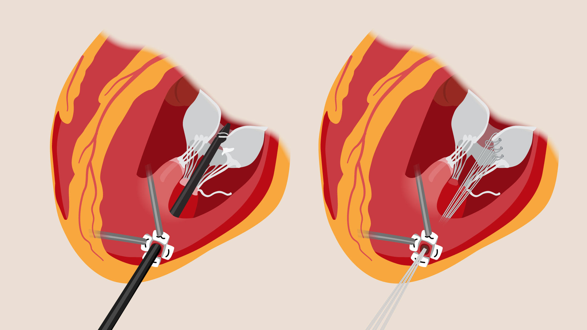 A diagram of the NeoChord beating heart mitral valve repair procedure