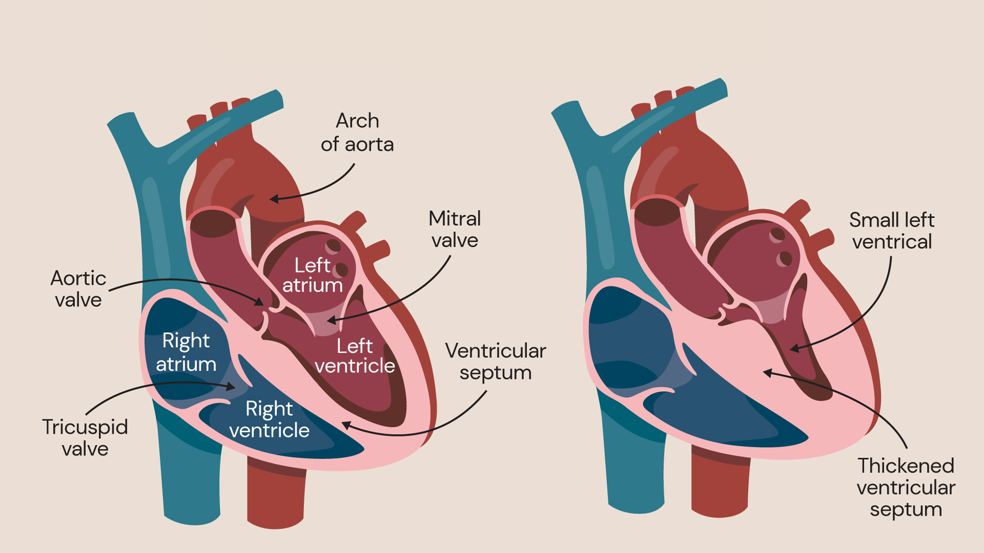 An illustration showing hypertrophic cardiomyopathy.