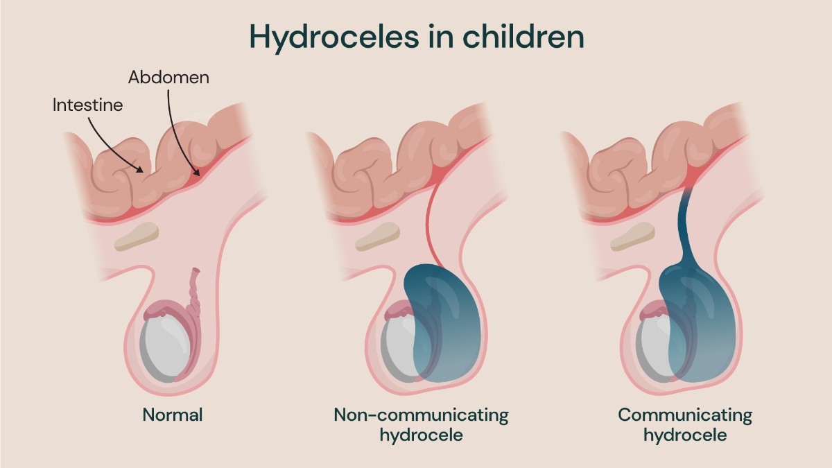 Three diagrams showing a normal scrotum, a non-communicating hydrocele and communicating hydrocele.