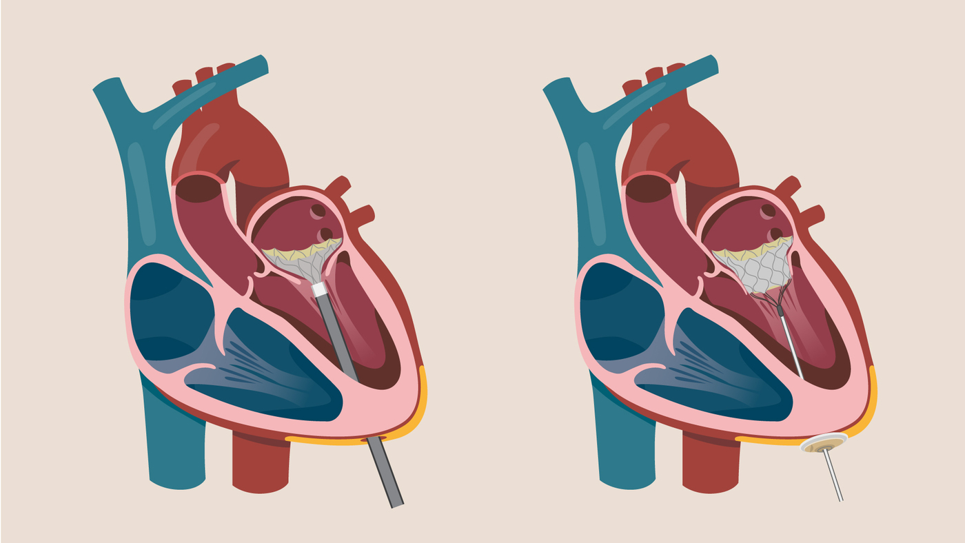 An illustration showing the Tendyne TMVR valve