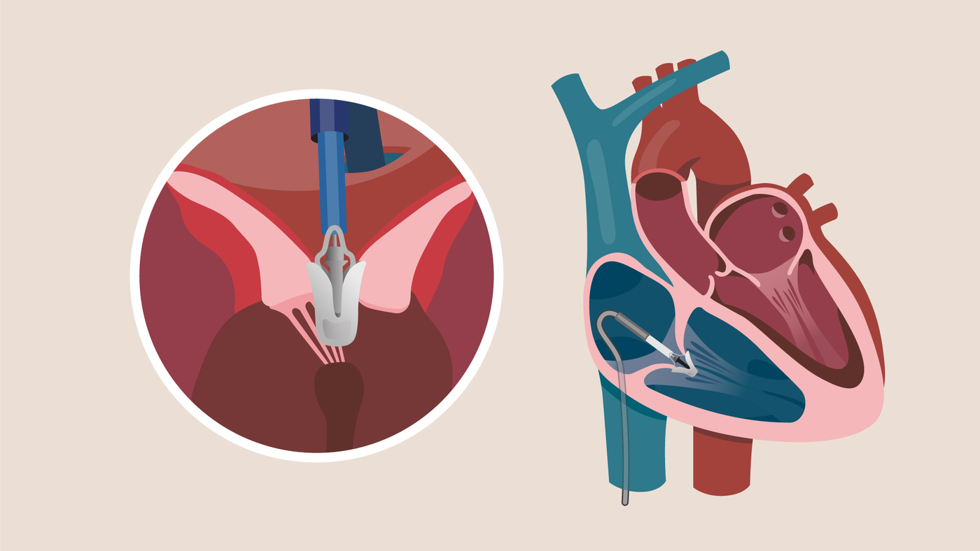 (Left) Edwards PASCAL transcatheter valve repair system, with the PASCAL ACE implantTM and (right) the Abbott TriClipTM Transcatheter Valve Repair system positioned in the heart.