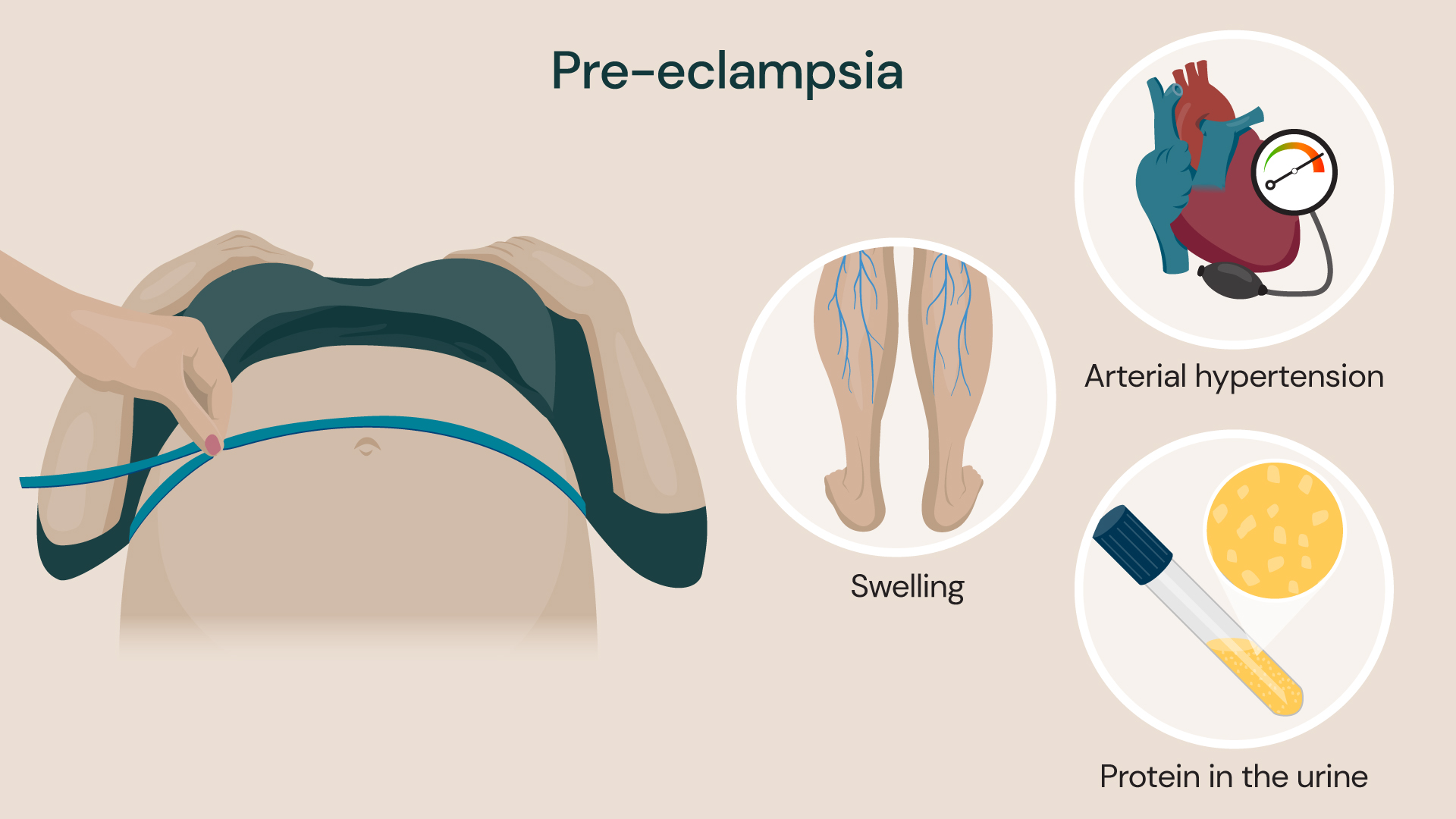 Illustration showing the symptoms of pre-eclampsia