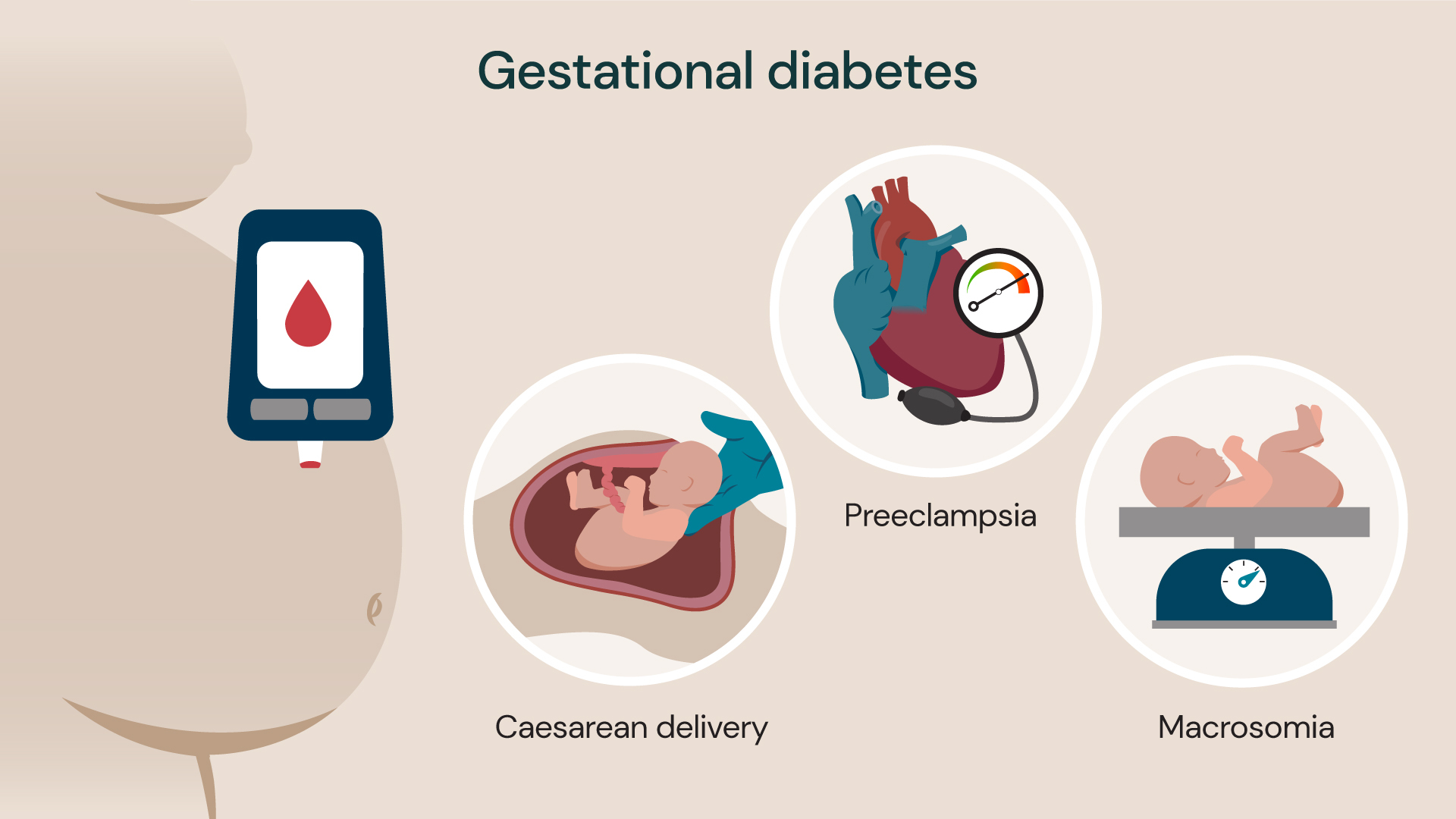 An illustration showing the possible risks of diabetes during pregnancy.