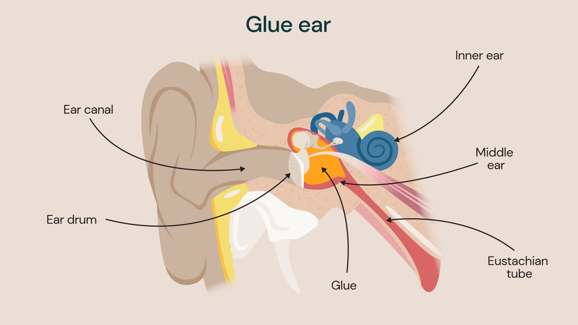 A cross section of the ear showing how glue ear develops.