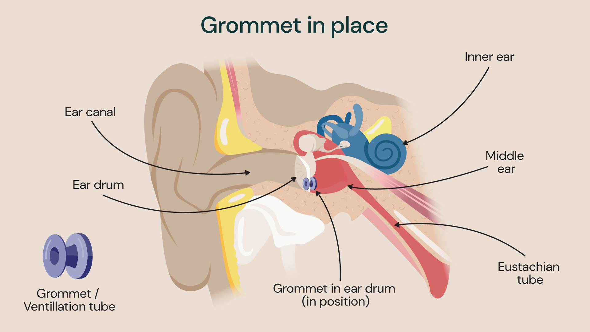 Illustration showing the inner ear with grommets in place to treat glue ear