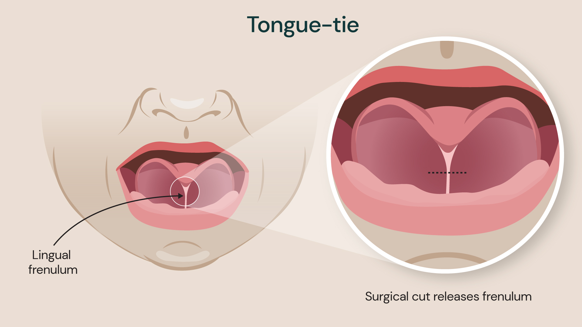 Illustration showing lingual frenulum known as tongue-tie, and surgical treatment severing the frenulum