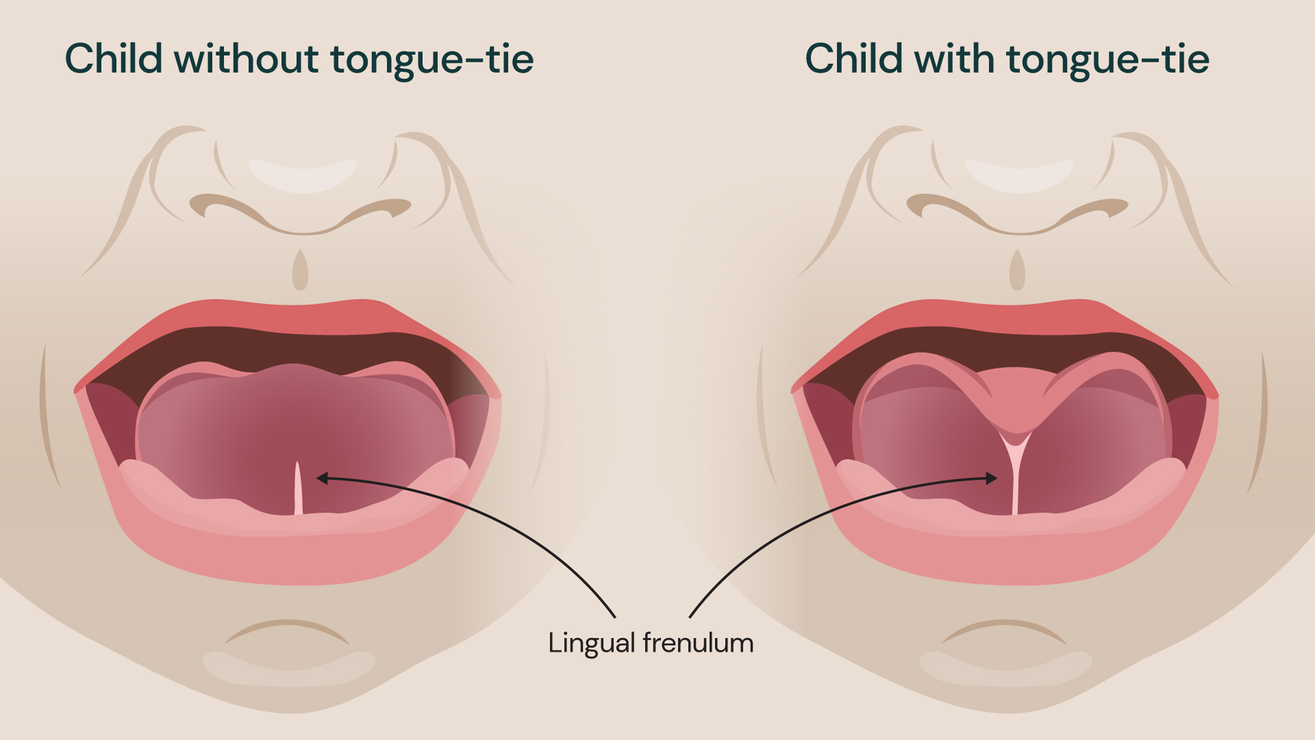 Illustration showing two different children, one with tongue-tie and one without