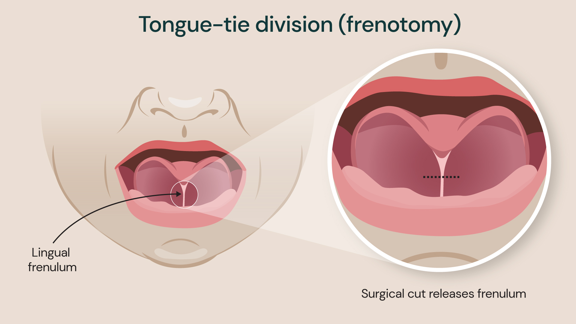 Illustration showing surgical treatment for tongue-tie known as frenotomy