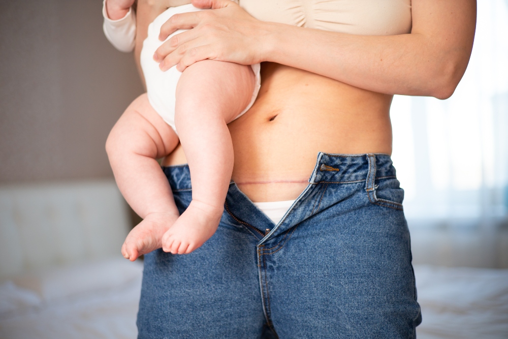 A young mother wearing jeans with button open showing caesarean scare holds baby in her arms.