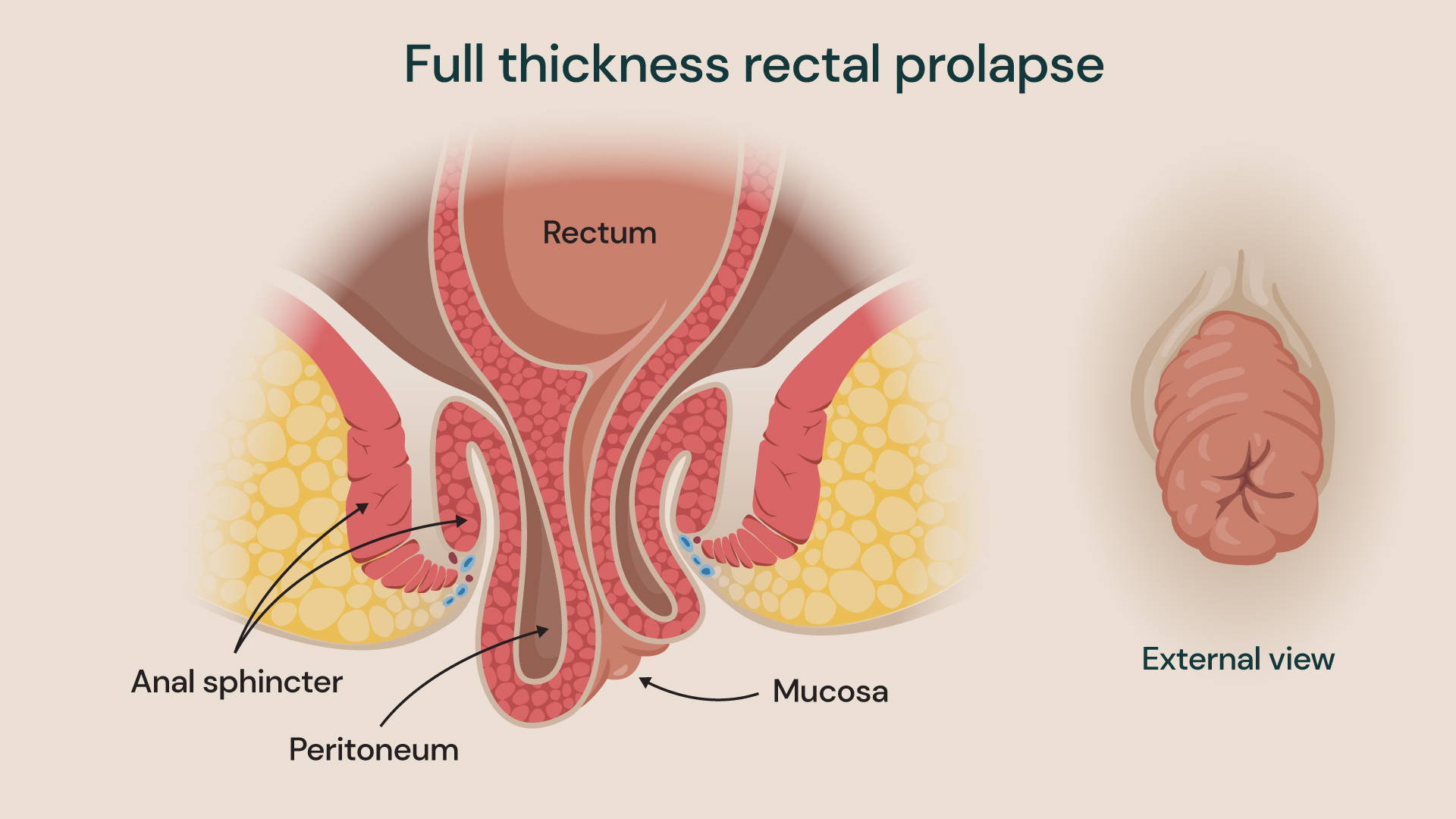 Full thickness rectal prolapse