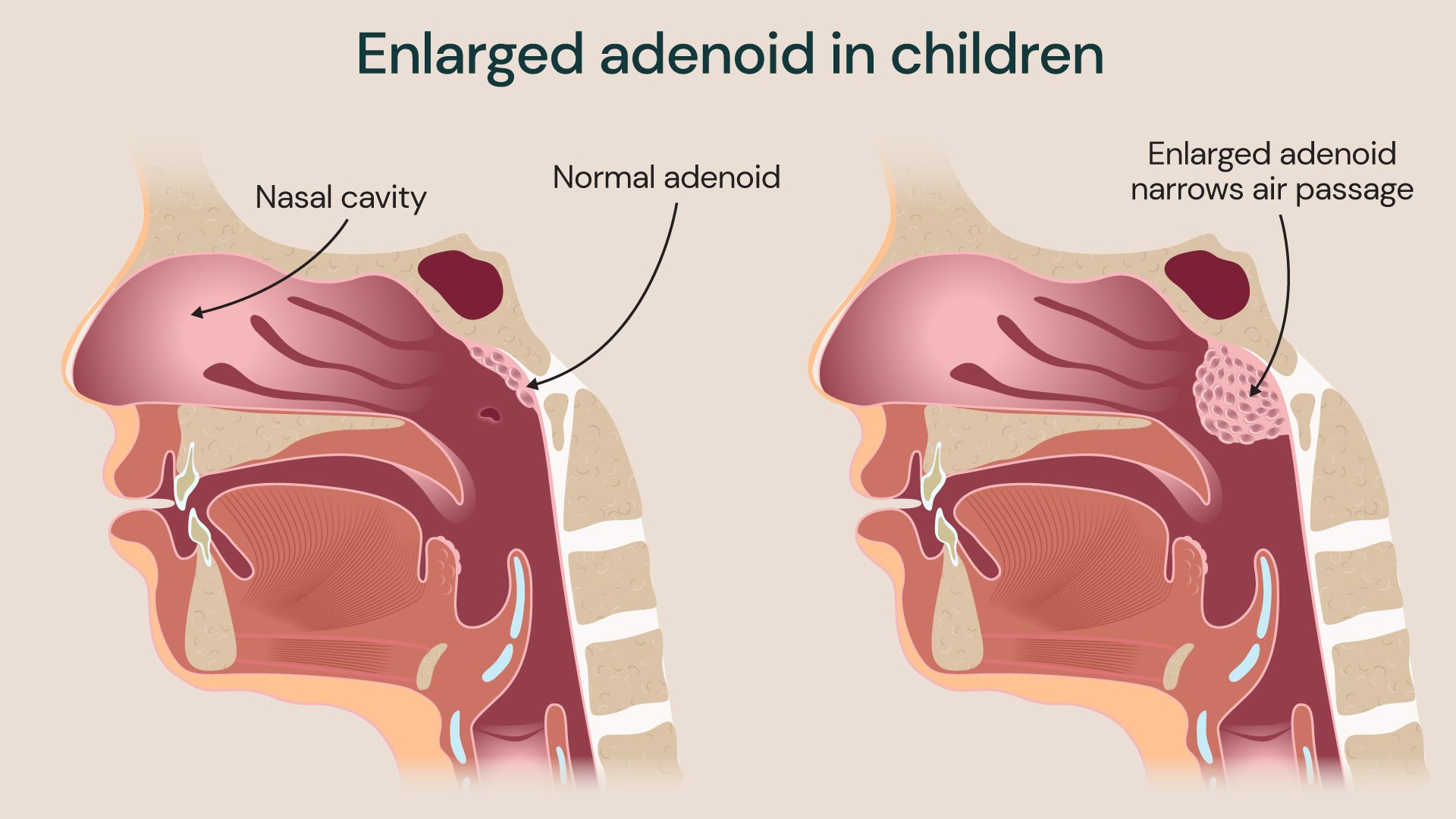 A normal adenoid compared to an enlarged one.