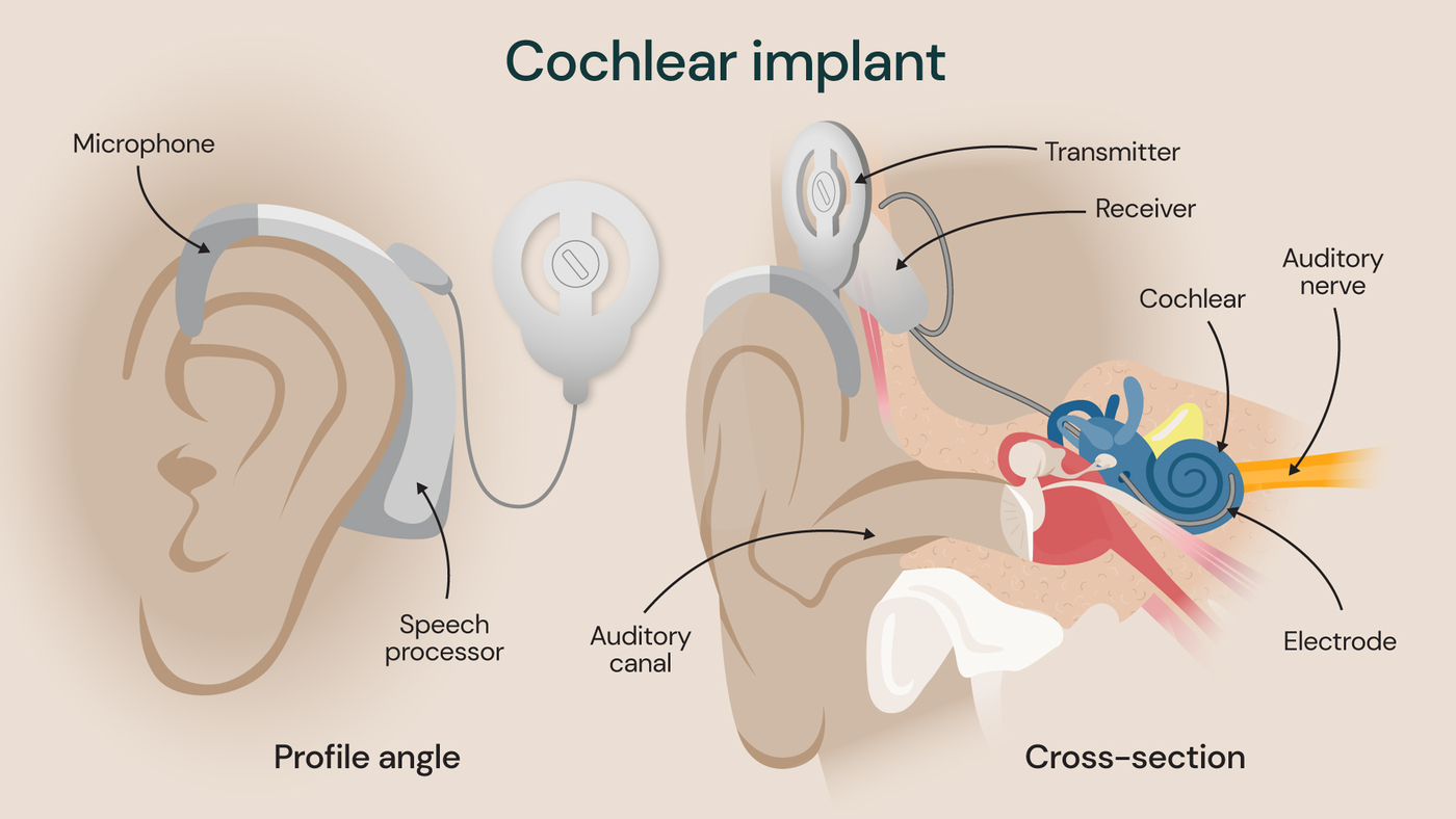 Cochlear implant, showing both the inside of the ear and the external view.