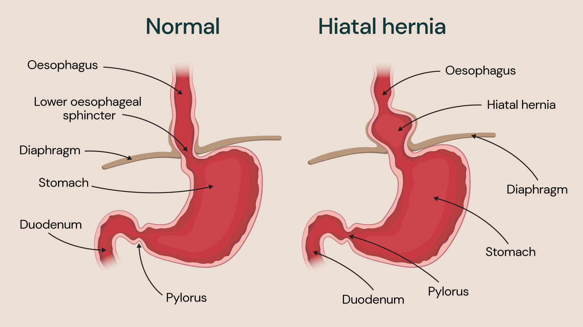 Hiatal Hernia diaphragmatic Hernia In Adults And Children Guys And 