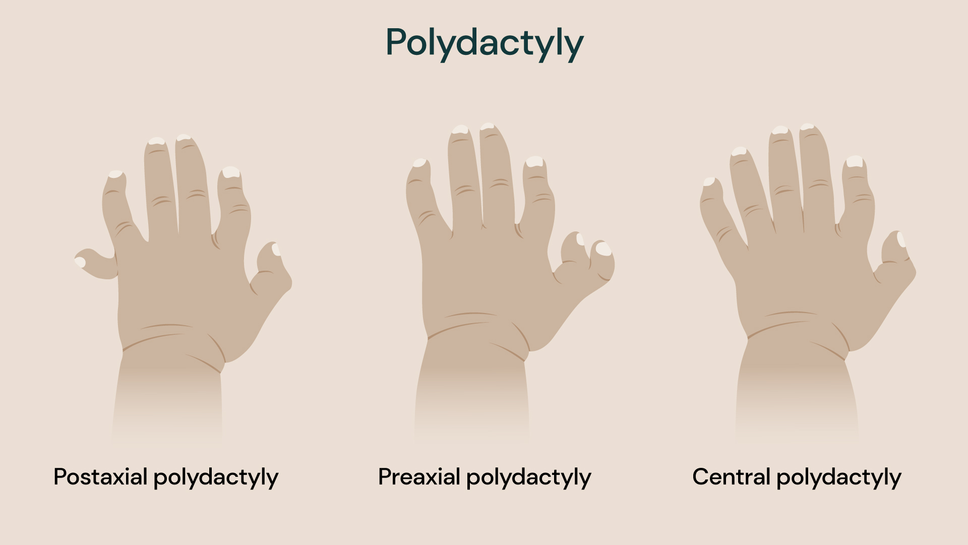 Medical illustration showing three examples of polydactyly in a child’s hand, labelled as postaxial polydactyly, preaxial polydactyly and central polydactyly.