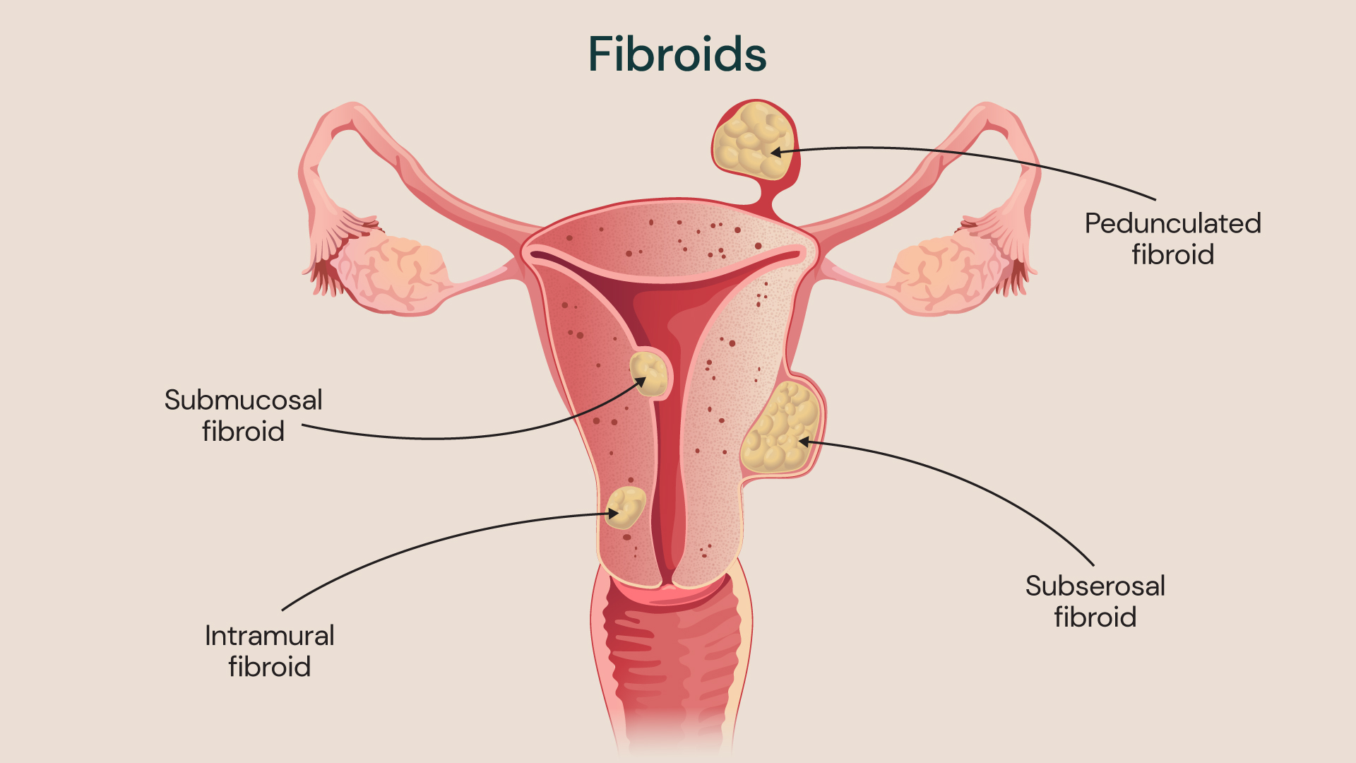 Illustration showing the different types of fibroids that can occur in the walls, lining, or outer surface of the uterus, and occasionally in the cervix or attached by a stalk to surrounding pelvic structures