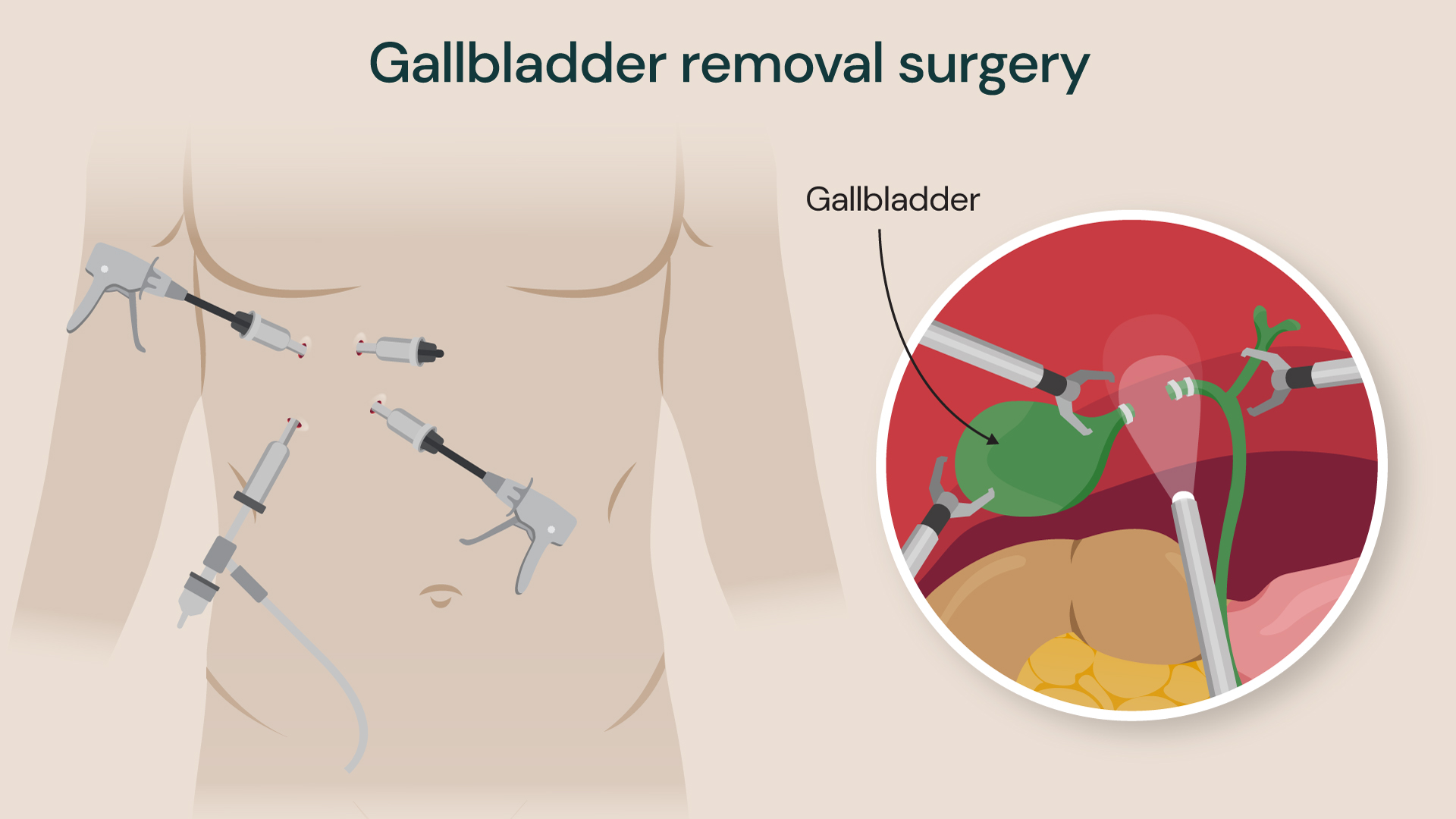 Medical illustration of laparoscopic gallbladder removal surgery showing surgical instruments inserted through small abdominal incisions and a close-up of the gallbladder being clipped and removed.