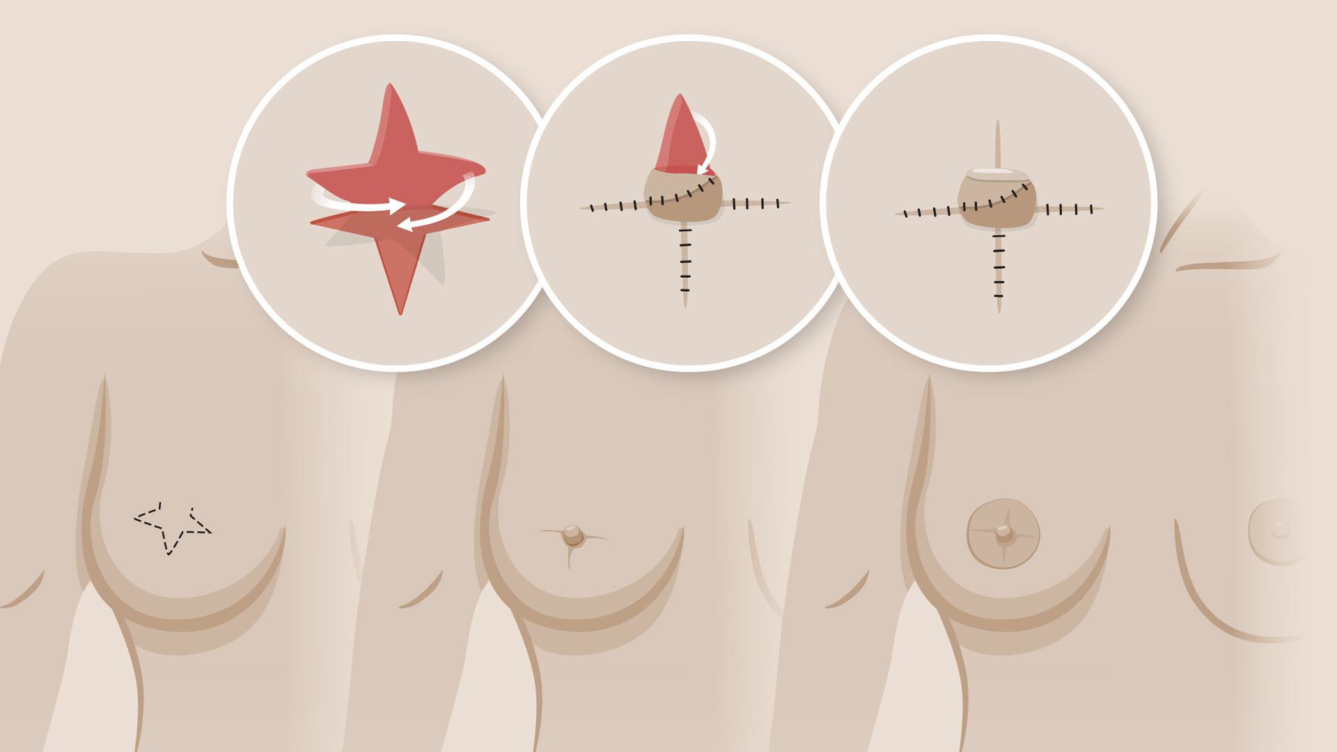 A nipple reconstruction