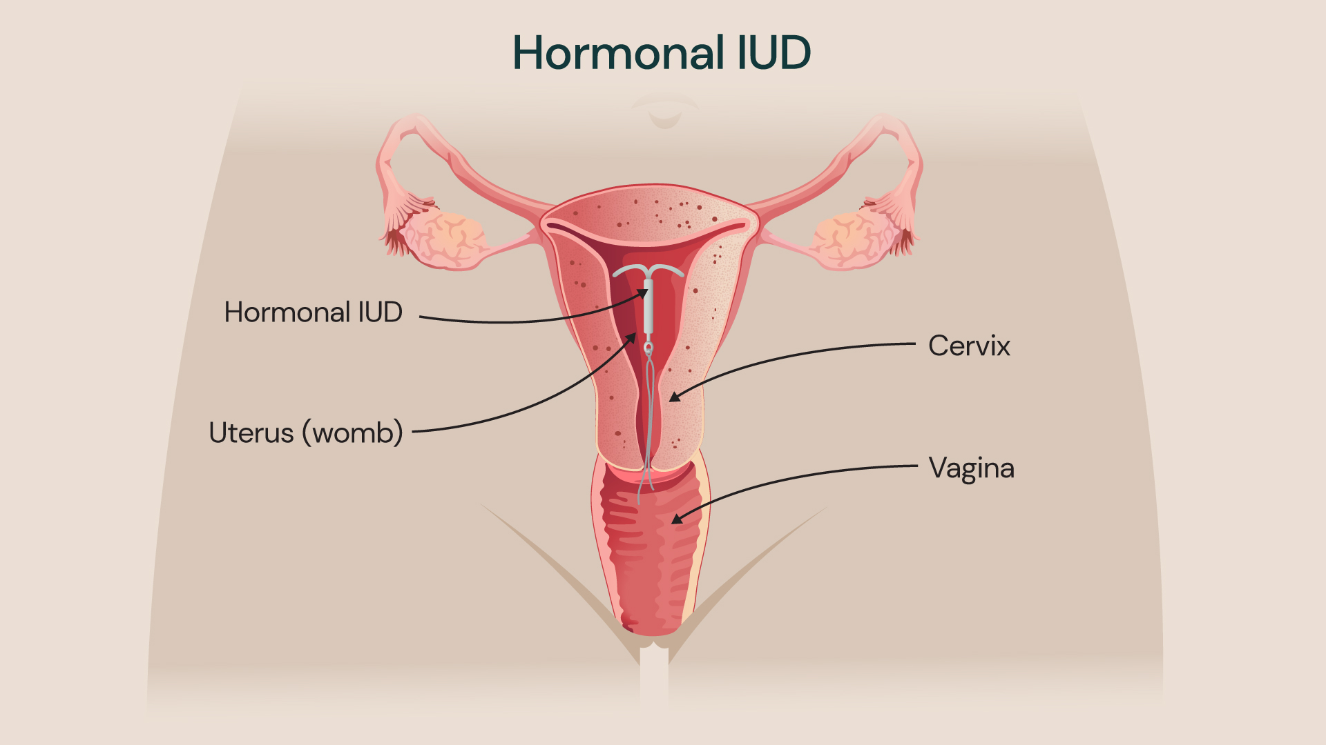 Illustration of a hormonal intrauterine device (IUD) placed inside the uterus, showing the cervix and vagina with labelled female reproductive anatomy.
