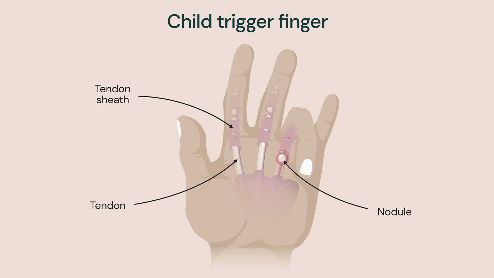 Medical illustration of a child's hand showing trigger finger. Labels identify the tendon, tendon sheath and a nodule on the flexor tendon, demonstrating how thickening can affect finger movement.