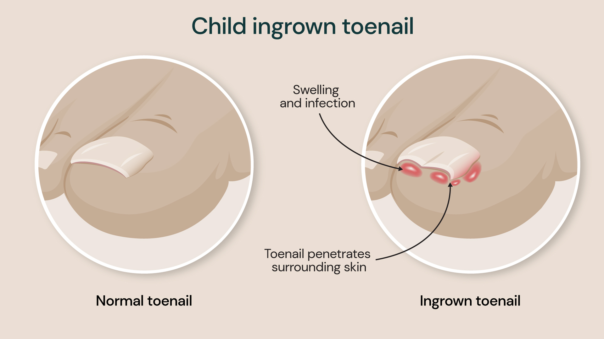 Medical illustration comparing a normal child’s toenail with an ingrown toenail. The ingrown toenail image shows the edge of the nail growing into the surrounding skin, causing swelling, redness and infection around the toe.