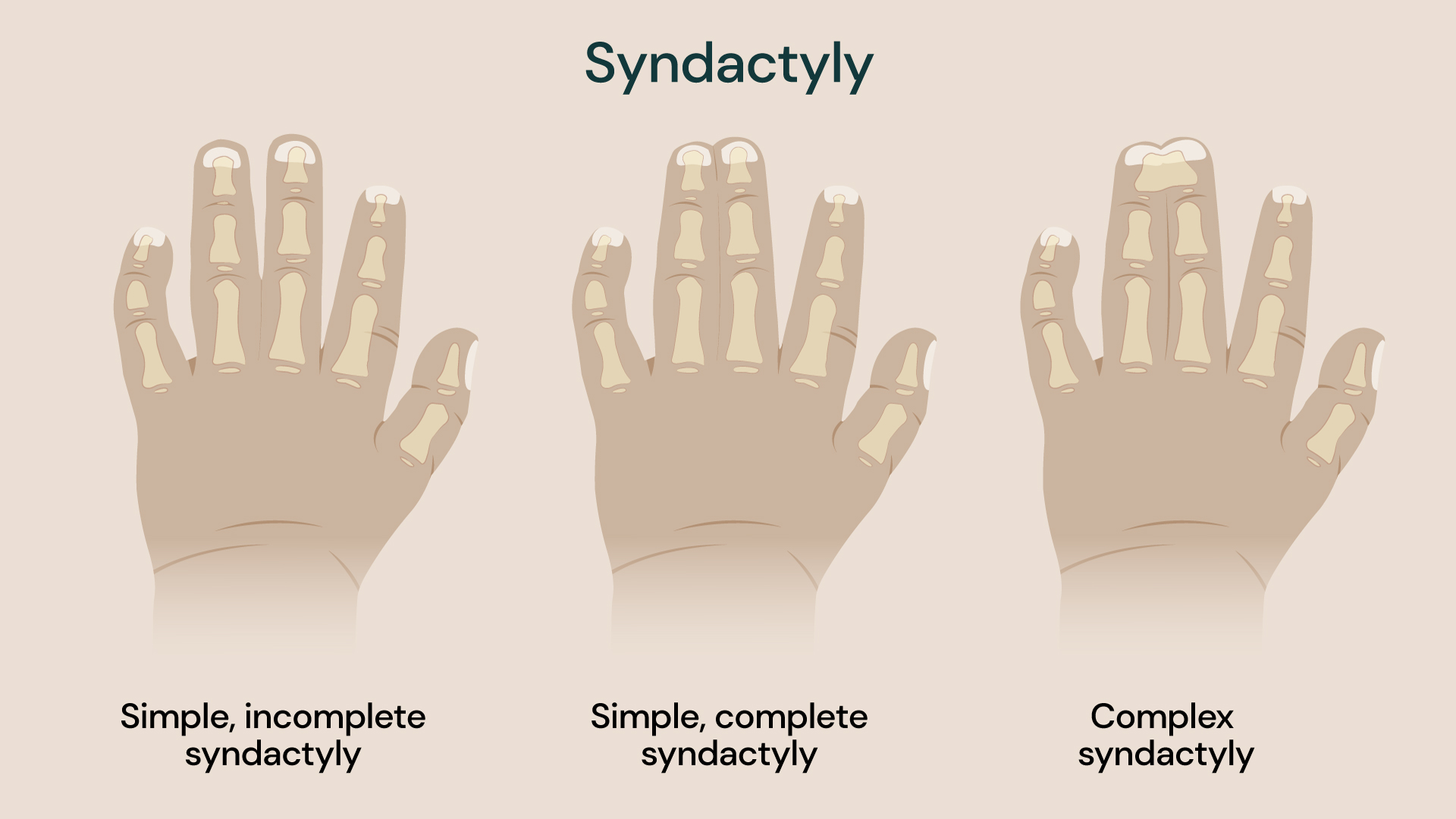 Medical illustration showing three types of syndactyly in a child’s hand. The image compares simple incomplete syndactyly, where fingers are partially joined; simple complete syndactyly, where fingers are joined along their full length; and complex syndactyly, where fingers are fused with involvement of deeper structures.