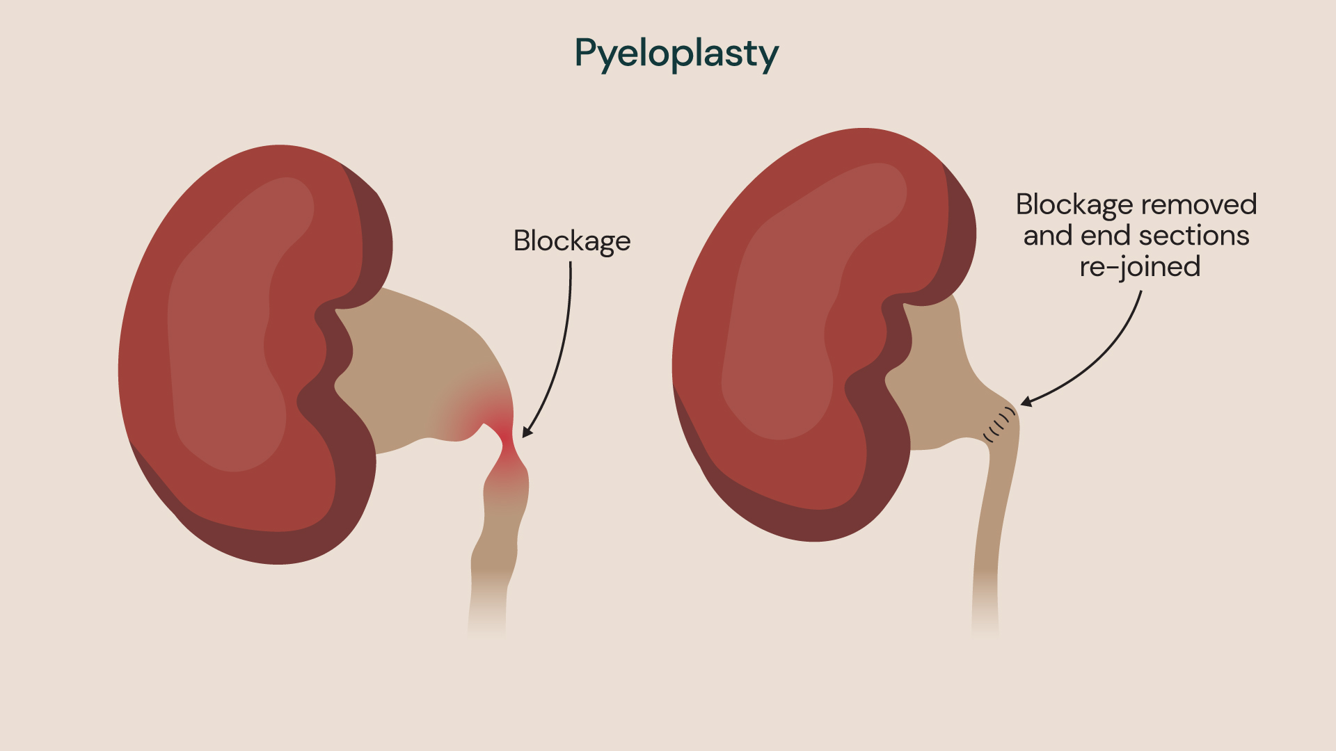 Medical illustration showing a kidney with a blockage at the junction between the kidney and ureter, alongside a second image showing the blocked section removed and the ureter rejoined during pyeloplasty surgery.